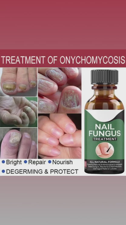 Fast Nail Fungal Treatment – Nail Repair Essence Serum & Foot Nail Fungus Removal Gel
